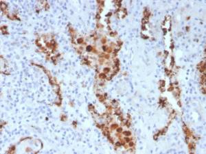 Immunohistochemical analysis of formalin-fixed, paraffin-embedded human lung adenocarcinoma using Anti-NAPSIN A Antibody [NAPSA/3307]