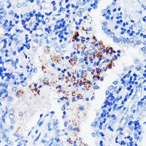 Immunohistochemistry analysis of paraffin-embedded human lung cancer using Anti-BTK Antibody [ARC0485] (A308271) at a dilution of 1:100 (40X lens). Perform microwave antigen retrieval with 10 mM PBS buffer pH 7.2 before commencing with IHC staining protocol