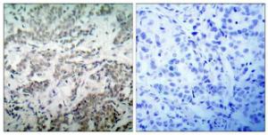 Immunohistochemical analysis of paraffin-embedded human breast carcinoma tissue using Anti-p53 Antibody. The right hand panel represents a negative control, where the antibody was pre-incubated with the immunising peptide