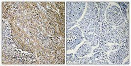 Immunohistochemical analysis of paraffin-embedded human lung cancer using Anti-CTPS Antibody 1:100 (4°C overnight). The right hand panel represents a negative control, where the antibody was pre-incubated with the immunising peptide