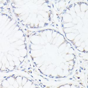 Immunohistochemistry analysis of paraffin-embedded human colon tissue using Anti-p53 Antibody (A308277) at a dilution of 1:100 (40X lens). Perform microwave antigen retrieval with 10 mM PBS buffer pH 7.2 before commencing with IHC staining protocol