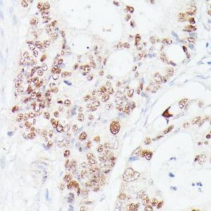 Immunohistochemistry analysis of paraffin-embedded human colon carcinoma tissue using Anti-p53 Antibody (A308277) at a dilution of 1:100 (40X lens). Perform microwave antigen retrieval with 10 mM PBS buffer pH 7.2 before commencing with IHC staining protocol