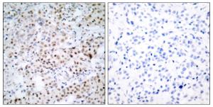 Immunohistochemical analysis of paraffin-embedded human breast carcinoma tissue using Anti-CREB Antibody. The right hand panel represents a negative control, where the antibody was pre-incubated with the immunising peptide