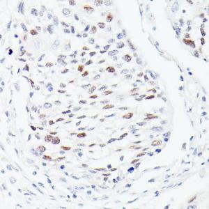 Immunohistochemistry analysis of paraffin-embedded human esophageal cancer using Anti-p53 Antibody (A308277) at a dilution of 1:100 (40X lens). Perform microwave antigen retrieval with 10 mM PBS buffer pH 7.2 before commencing with IHC staining protocol