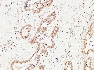 Immunohistochemical analysis of paraffin-embedded human Mammary cancer using Anti-c-Kit Antibody