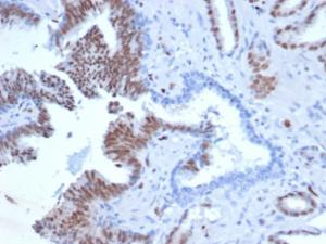 Immunohistochemical analysis of formalin-fixed, paraffin-embedded human prostate tissue using Anti-ERG Antibody [rERG/6843] at 2µg/ml