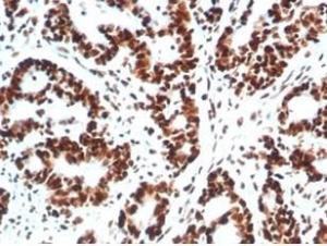 Immunohistochemical analysis of formalin-fixed, paraffin-embedded human colon carcinoma tissue using Anti-Ku80 Antibody [XRCC5/7317]