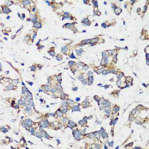 Immunohistochemistry analysis of paraffin-embedded human gastric cancer using Anti-Hamartin Antibody (A12695) at a dilution of 1:200 (40x lens). Perform microwave antigen retrieval with 10 mM PBS buffer pH 7.2 before commencing with IHC staining protocol