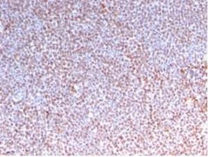 Immunohistochemical analysis of formalin-fixed, paraffin-embedded human anaplastic large cell lymphoma tissue using Anti-ALK Antibody [rALK1/1504]