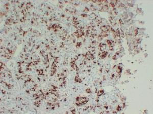 Immunohistochemical analysis of paraffin-embedded human Hyperprolaceinemia using Anti-Prolactin Antibody