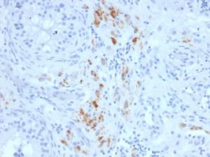 Immunohistochemical analysis of formalin-fixed, paraffin-embedded human testicular carcinoma using Anti-StAR Antibody [STAR/2140]