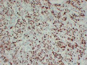 Immunohistochemical analysis of paraffin-embedded human Hyperprolaceinemia using Anti-Prolactin Antibody