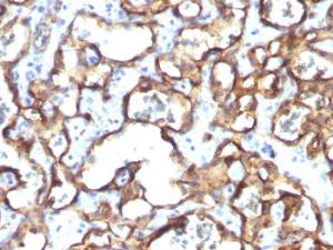 Immunohistochemical analysis of formalin-fixed, paraffin-embedded human angiosarcoma using Anti-CD34 Antibody [HPCA1/1171]