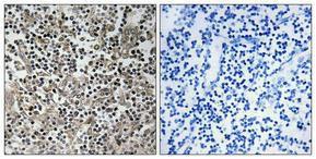 Immunohistochemical analysis of paraffin-embedded human lung cancer using Anti-p47 phox Antibody 1:100 (4°C overnight). The right hand panel represents a negative control, where the antibody was pre-incubated with the immunising peptide.