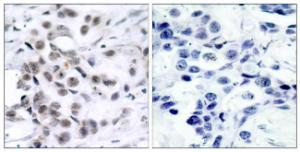 Immunohistochemical analysis of paraffin-embedded human breast carcinoma tissue using Anti-Chk1 Antibody. The right hand panel represents a negative control, where the antibody was pre-incubated with the immunising peptide.