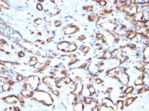 Immunohistochemical analysis of formalin-fixed, paraffin-embedded human angiosarcoma using Anti-CD34 Antibody [SPM610]