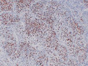 Immunohistochemical analysis of paraffin-embedded human Rhabdomyosarcoma using Anti-Myogenin Antibody