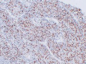 Immunohistochemical analysis of paraffin-embedded human Rhabdomyosarcoma using Anti-Myogenin Antibody