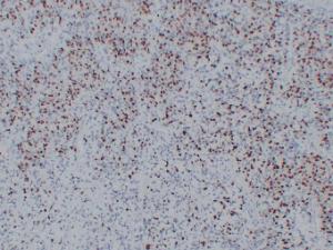 Immunohistochemical analysis of paraffin-embedded human Rhabdomyosarcoma using Anti-Myogenin Antibody