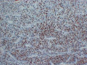 Immunohistochemical analysis of paraffin-embedded human Rhabdomyosarcoma using Anti-Myogenin Antibody