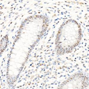 Immunohistochemistry analysis of paraffin-embedded human appendix tissue using Anti-PMS2 Antibody [ARC1039] (A307272) at a dilution of 1:100(40x lens). Perform high pressure antigen retrieval with 10 mM citrate buffer pH 6.0 before commencing with IHC staining protocol.