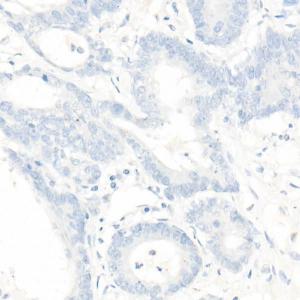 Immunohistochemistry analysis of paraffin-embedded human colon cancer loss of PMS2 expression (negative control samples) using Anti-PMS2 Antibody [ARC1039] (A307272) at a dilution of 1:100(40x lens