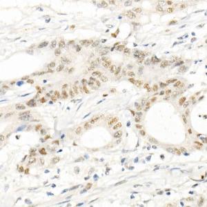 Immunohistochemistry analysis of paraffin-embedded human colon carcinoma tissue using Anti-PMS2 Antibody [ARC1039] (A307272) at a dilution of 1:100(40x lens). Perform high pressure antigen retrieval with 10 mM citrate buffer pH 6.0 before commencing with IHC staining protocol.