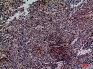 Immunohistochemical analysis of paraffin-embedded human lung cancer using Anti-CDC34 Antibody