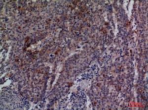 Immunohistochemical analysis of paraffin-embedded human lung cancer using Anti-CDC34 Antibody