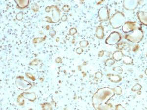 Immunohistochemical analysis of formalin-fixed, paraffin-embedded human renal cell carcinoma using Anti-STAT6 Antibody [STAT6/2410]