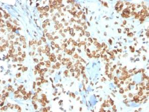 Immunohistochemical analysis of formalin-fixed, paraffin-embedded human breast carcinoma using Anti-Emerin Antibody [EMD/2167]