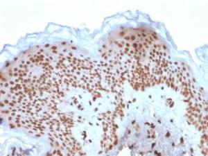 Immunohistochemical analysis of formalin-fixed, paraffin-embedded human basal cell carcinoma using Anti-Emerin Antibody [EMD/2167]