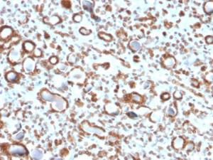 Immunohistochemical analysis of formalin-fixed, paraffin-embedded human renal cell carcinoma using Anti-Emerin Antibody [EMD/2167]