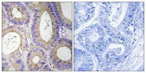 Immunohistochemical analysis of paraffin-embedded human colon carcinoma tissue using Anti-CBR3 Antibody. The right hand panel represents a negative control, where the Antibody was pre-incubated with the immunising peptide