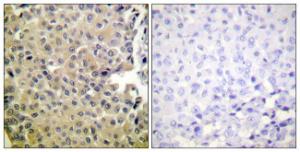 Immunohistochemical analysis of paraffin-embedded human breast carcinoma using Anti-PP1-alpha (phospho Thr320) Antibody. The right hand panel represents a negative control, where the antibody was pre-incubated with the immunising peptide