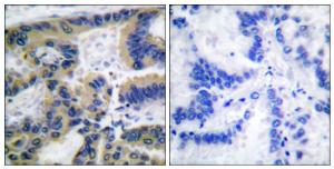 Immunohistochemical analysis of paraffin-embedded human lung carcinoma tissue using Anti-Caspase 7 (cleaved Asp198) Antibody. The right hand panel represents a negative control, where the antibody was pre-incubated with the immunising peptide.