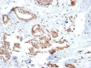 Immunohistochemical analysis of formalin-fixed, paraffin-embedded human breast carcinoma using Anti-SOX4 Antibody [SOX4/2540]