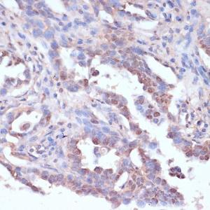 Immunohistochemistry analysis of paraffin-embedded human lung cancer using Anti-CART Antibody (A305732) at a dilution of 1:100 (40X lens). Perform microwave antigen retrieval with 10 mM PBS buffer pH 7.2 before commencing with IHC staining protocol