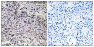 Immunohistochemical analysis of paraffin-embedded human lung carcinoma tissue using Anti-C1QC Antibody. The right hand panel represents a negative control, where the antibody was pre-incubated with the immunising peptide.