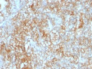 Immunohistochemical analysis of formalin-fixed, paraffin-embedded human renal cell carcinoma using Anti-CD147 Antibody [8D6]