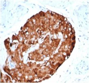 Immunohistochemical analysis of formalin-fixed, paraffin-embedded human testicular carcinoma using Anti-Inhibin alpha Antibody [rINHA/6919] at 2 µg/ml in PBS for 30  minutes at room temperature