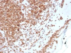 Immunohistochemical analysis of formalin-fixed, paraffin-embedded human basal cell carcinoma using Anti-Emerin Antibody [EMD/2168]