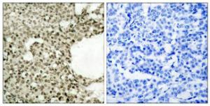 Immunohistochemical analysis of paraffin-embedded human breast carcinoma using Anti-STAT1 (phospho Ser727) Antibody. The right hand panel represents a negative control, where the antibody was pre-incubated with the immunising peptide