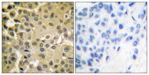 Immunohistochemical analysis of paraffin-embedded human breast carcinoma using Anti-Smad3 (phospho Ser425) Antibody. The right hand panel represents a negative control, where the antibody was pre-incubated with the immunising peptide.