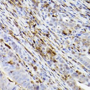 Immunohistochemistry analysis of paraffin-embedded human colon carcinoma tissue using Anti-Ferritin Heavy Chain Antibody [ARC2665] (A308297) at a dilution of 1:100 (40x lens)