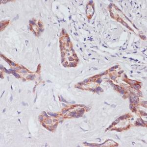 Immunohistochemistry analysis of paraffin-embedded human liver cancer using Anti-RAP1A Antibody (A12733) at a dilution of 1:100 (40X lens). Perform microwave antigen retrieval with 10 mM PBS buffer pH 7.2 before commencing with IHC staining protocol