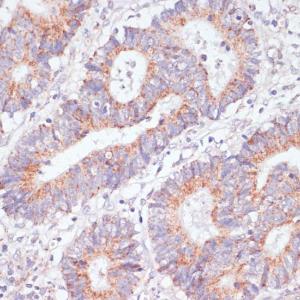 Immunohistochemistry analysis of paraffin-embedded human colon carcinoma tissue using Anti-RAP1A Antibody (A12733) at a dilution of 1:100 (40X lens). Perform microwave antigen retrieval with 10 mM PBS buffer pH 7.2 before commencing with IHC staining protocol