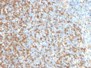 Immunohistochemical analysis of formalin-fixed, paraffin-embedded human follicular lymphoma using Anti-LMO2 Antibody [LMO2/1971]