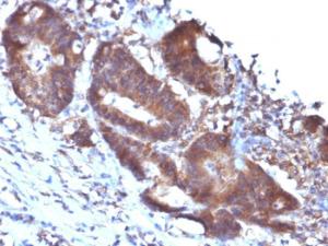 Immunohistochemical analysis of formalin-fixed, paraffin-embedded human colon carcinoma using Anti-Transgelin Antibody [TAGLN/247]