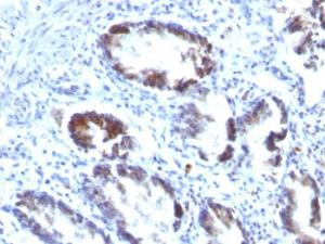 Immunohistochemical analysis of formalin-fixed, paraffin-embedded human colon carcinoma using Anti-Transgelin Antibody [TAGLN/247]